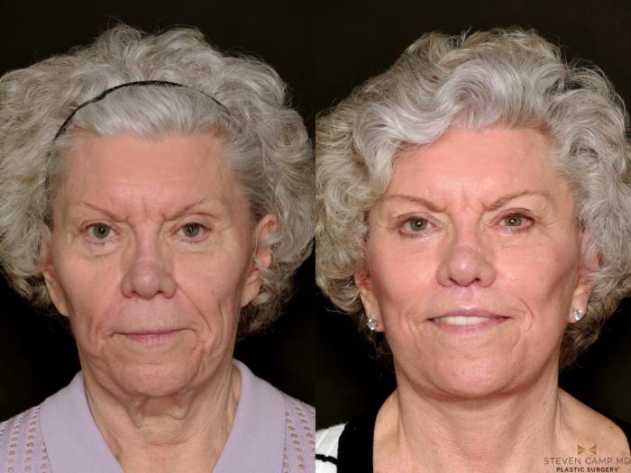 Before & After Blepharoplasty Case 737 Front View in Fort Worth & Arlington, Texas