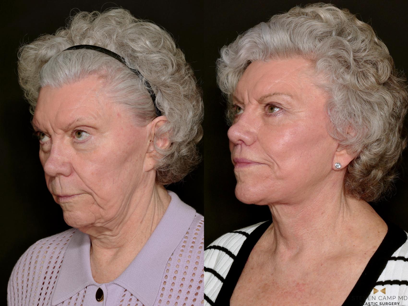 Before & After Blepharoplasty Case 737 Left Oblique View in Fort Worth & Arlington, Texas