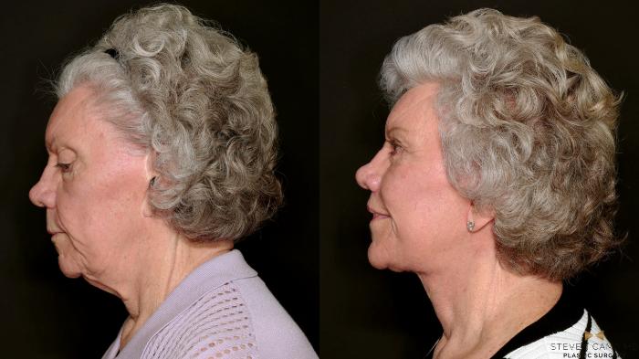Before & After Blepharoplasty Case 737 Left Side View in Fort Worth & Arlington, Texas