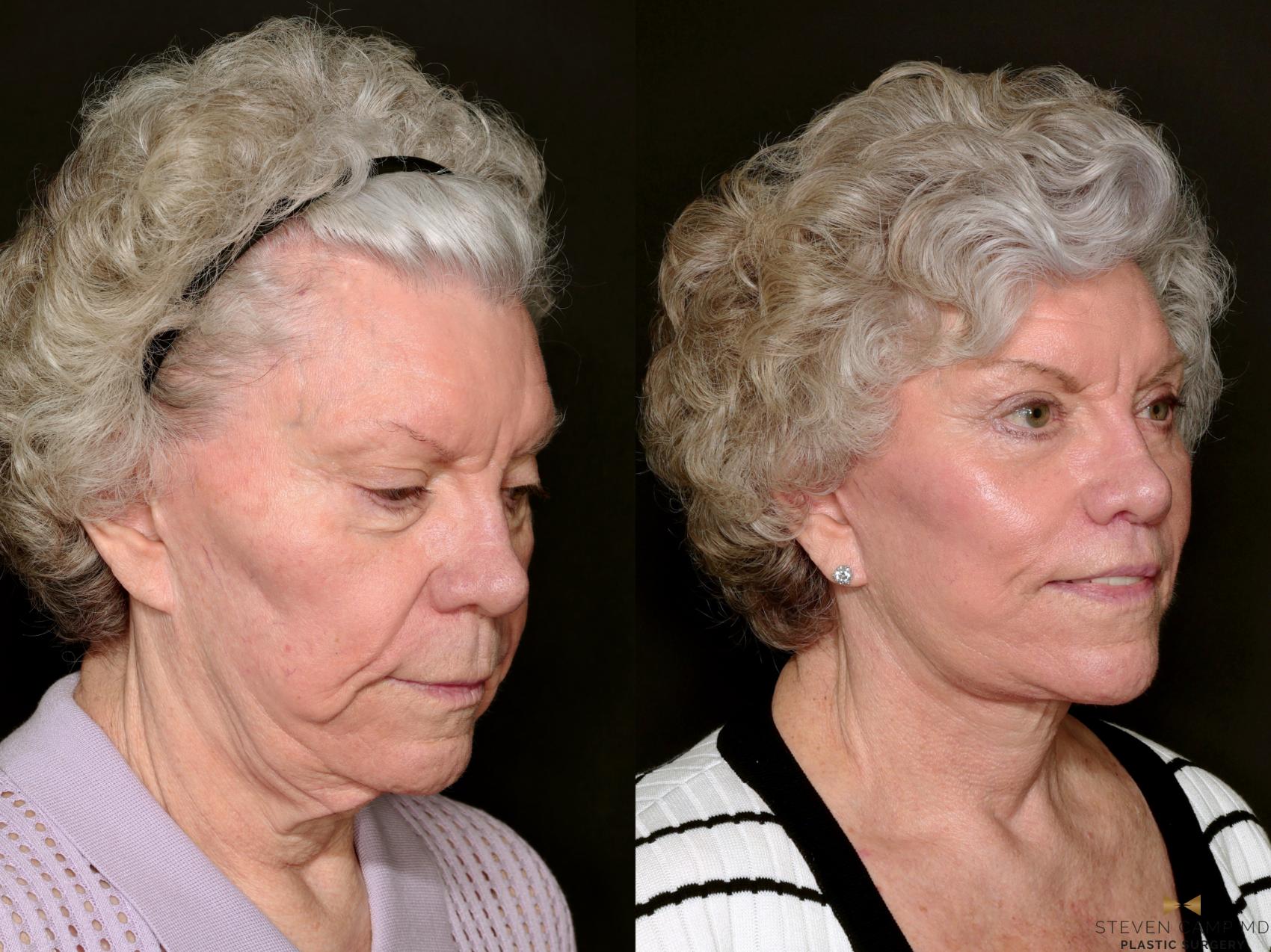 Before & After Blepharoplasty Case 737 Right Oblique View in Fort Worth & Arlington, Texas