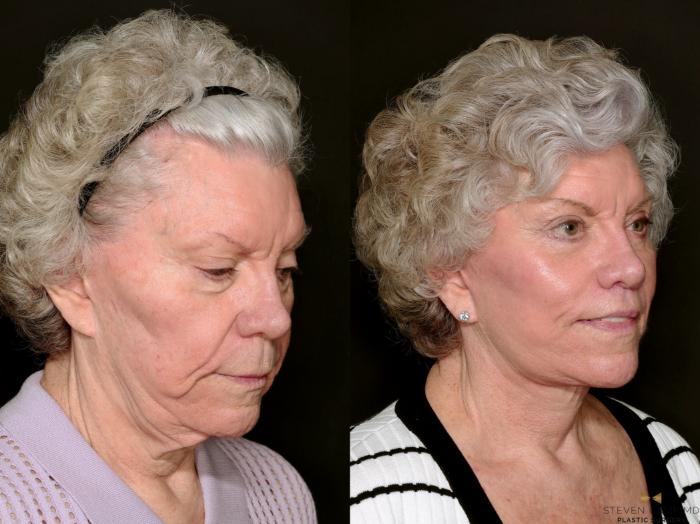 Before & After Blepharoplasty Case 737 Right Oblique View in Fort Worth & Arlington, Texas