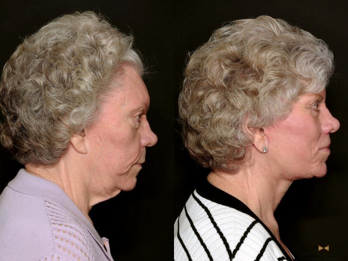 Before & After Blepharoplasty Case 737 Right Side View in Fort Worth & Arlington, Texas