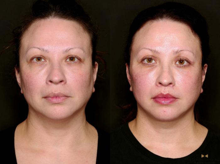 Before & After Facial Fat Grafting Case 743 Front View in Fort Worth & Arlington, Texas