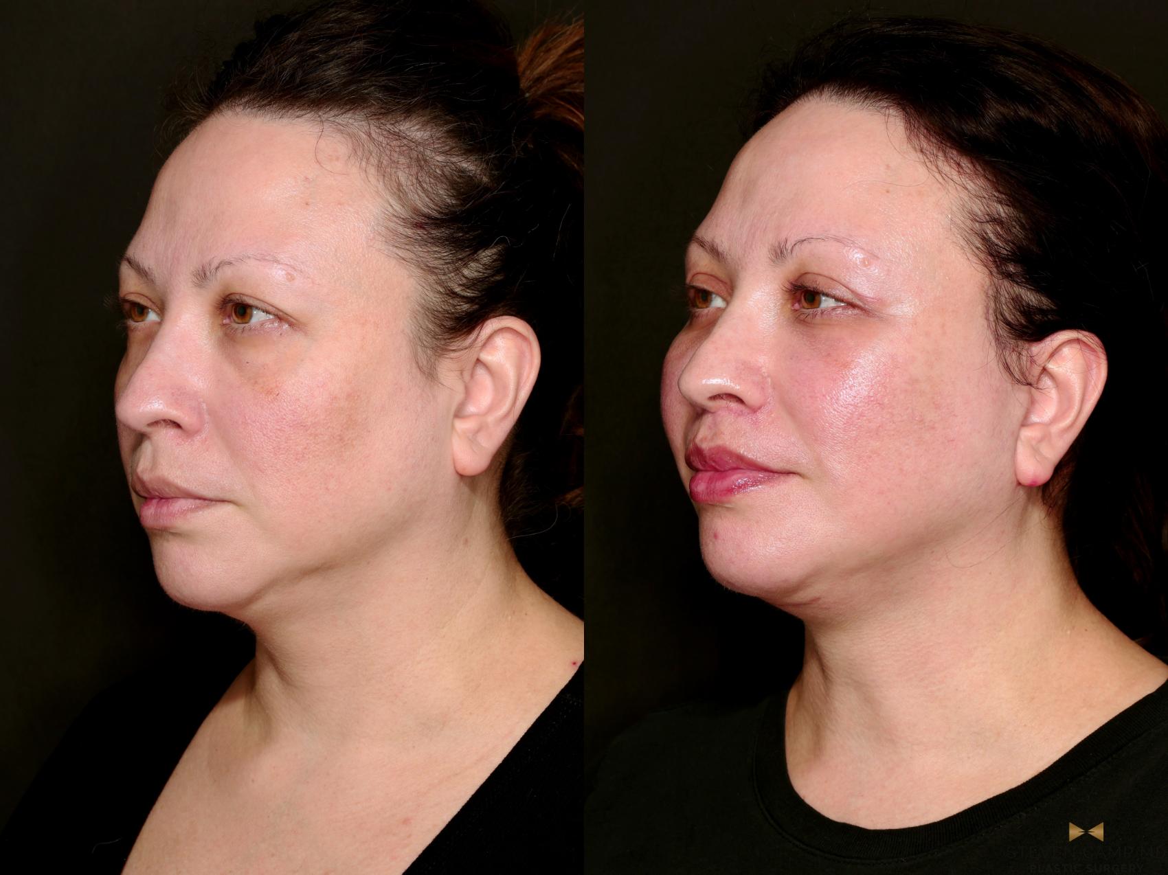 Before & After Facial Fat Grafting Case 743 Left Oblique View in Fort Worth & Arlington, Texas