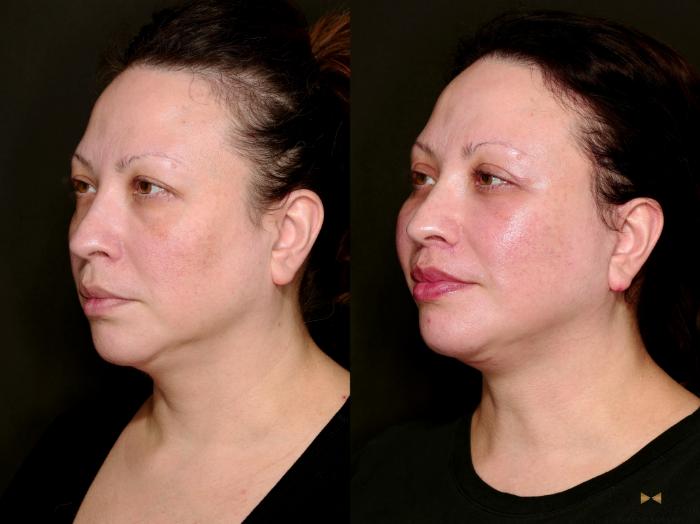 Before & After Facial Fat Grafting Case 743 Left Oblique View in Fort Worth & Arlington, Texas