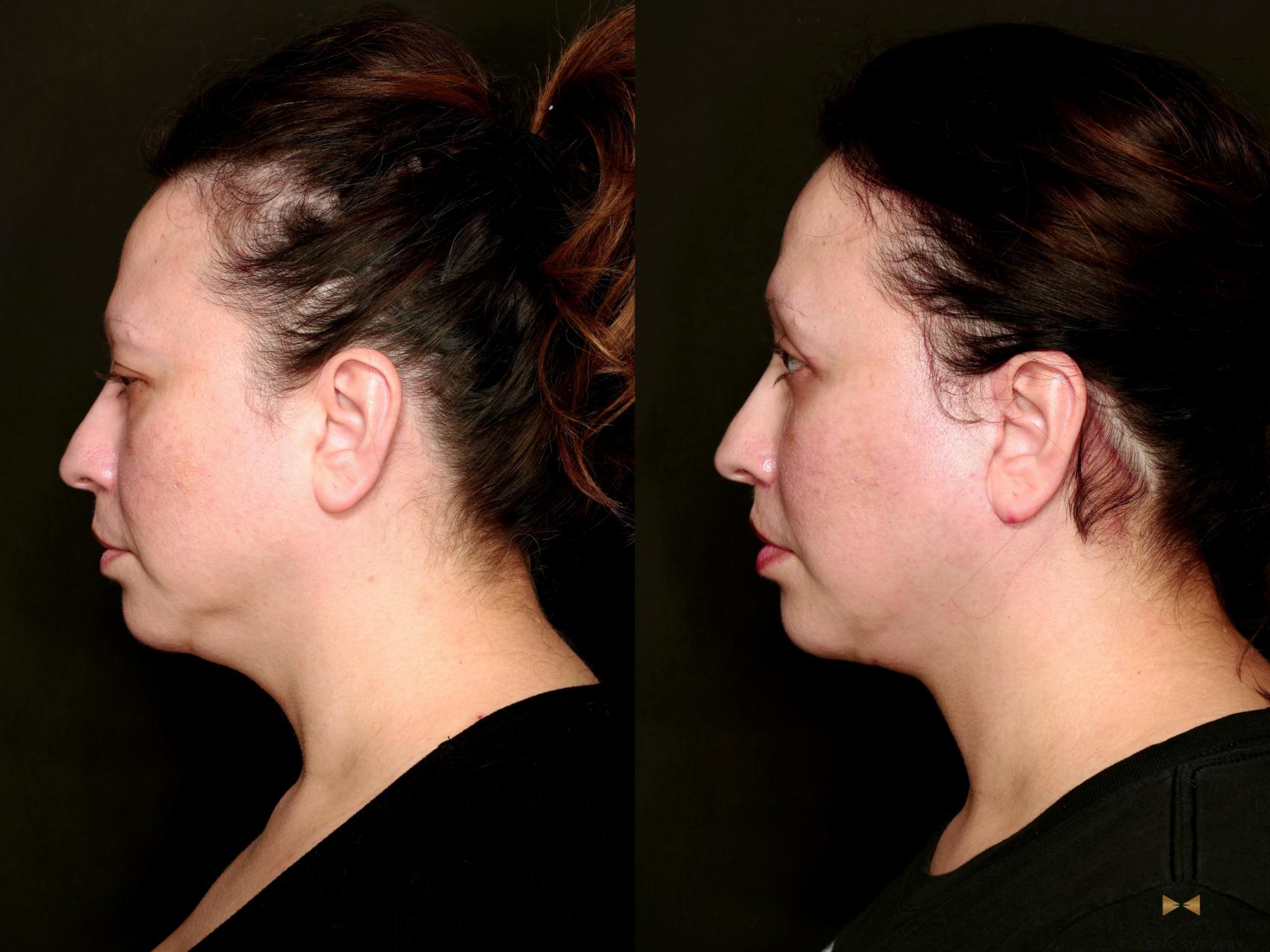 Before & After Facial Fat Grafting Case 743 Left Side View in Fort Worth & Arlington, Texas