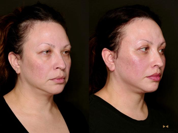 Before & After Facial Fat Grafting Case 743 Right Oblique View in Fort Worth & Arlington, Texas