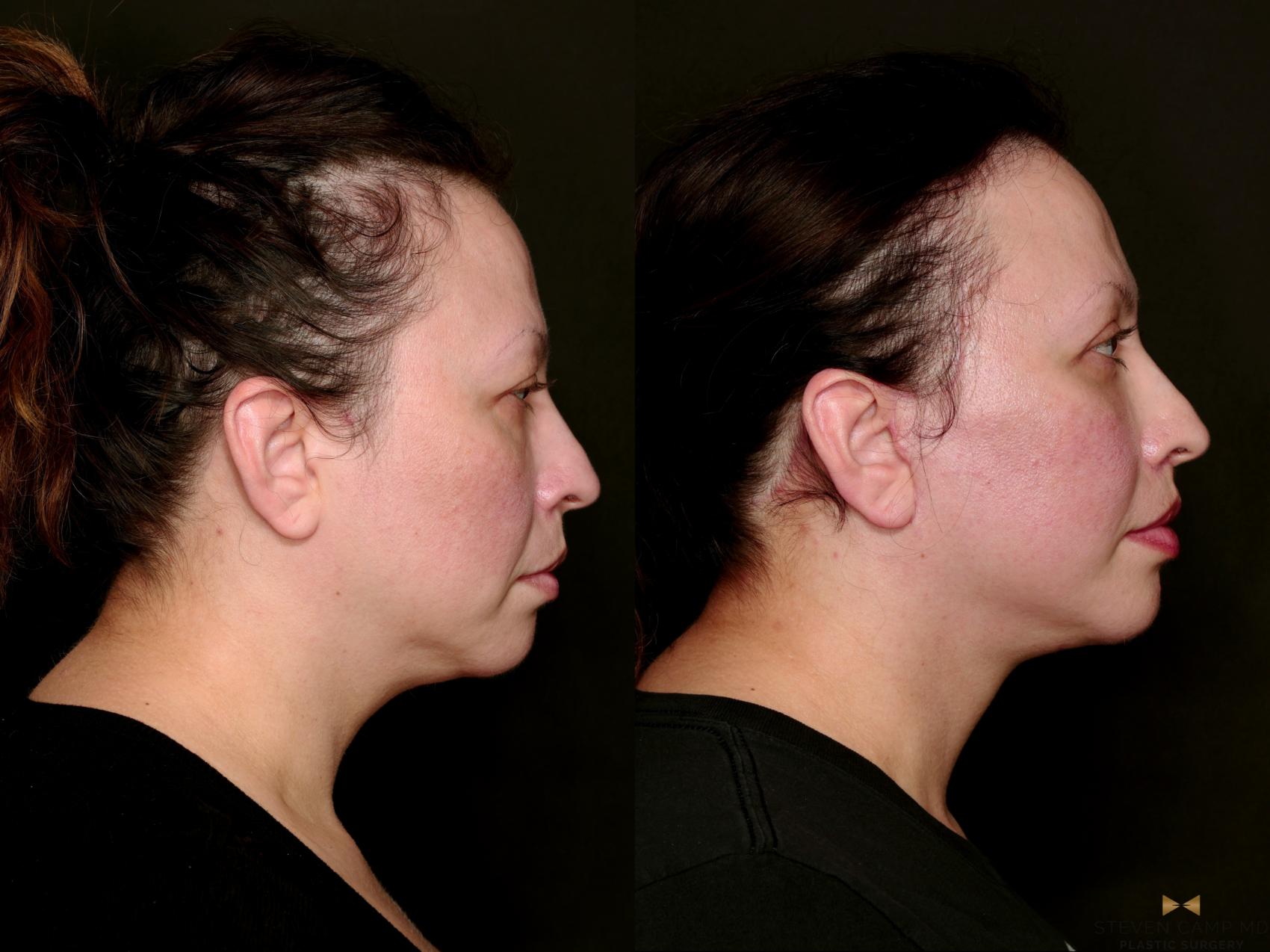 Before & After Facial Fat Grafting Case 743 Right Side View in Fort Worth & Arlington, Texas