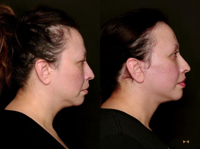 Before & After Facial Fat Grafting Case 743 Right Side View in Fort Worth & Arlington, Texas