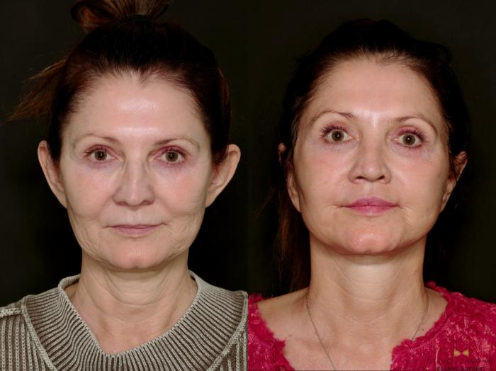 Before & After Deep Plane Facelift Case 745 Front View in Fort Worth & Arlington, Texas