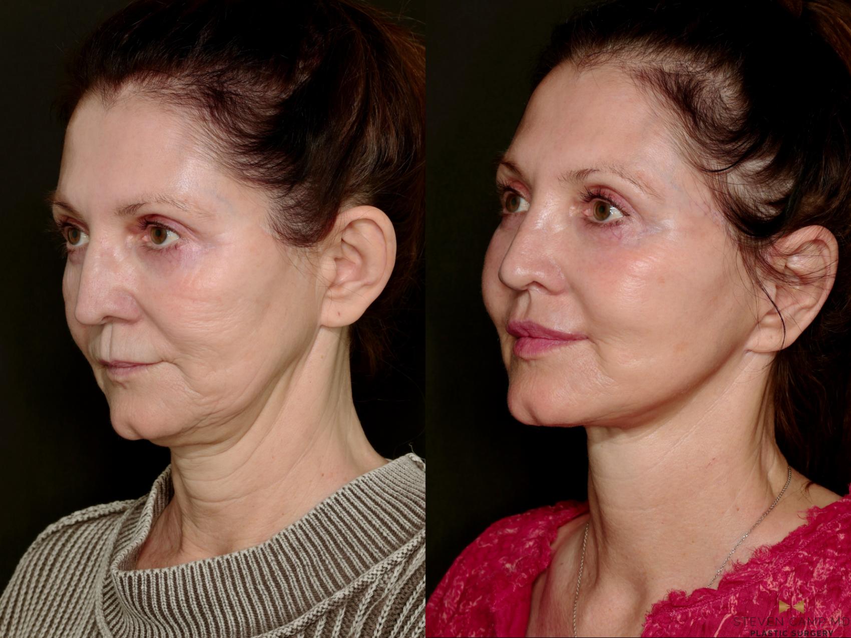 Before & After Deep Plane Facelift Case 745 Left Oblique View in Fort Worth & Arlington, Texas