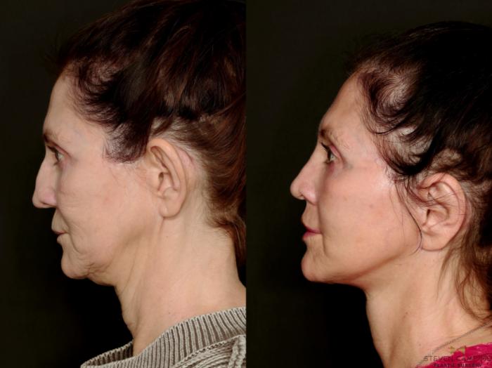 Before & After Deep Plane Facelift Case 745 Left Side View in Fort Worth & Arlington, Texas