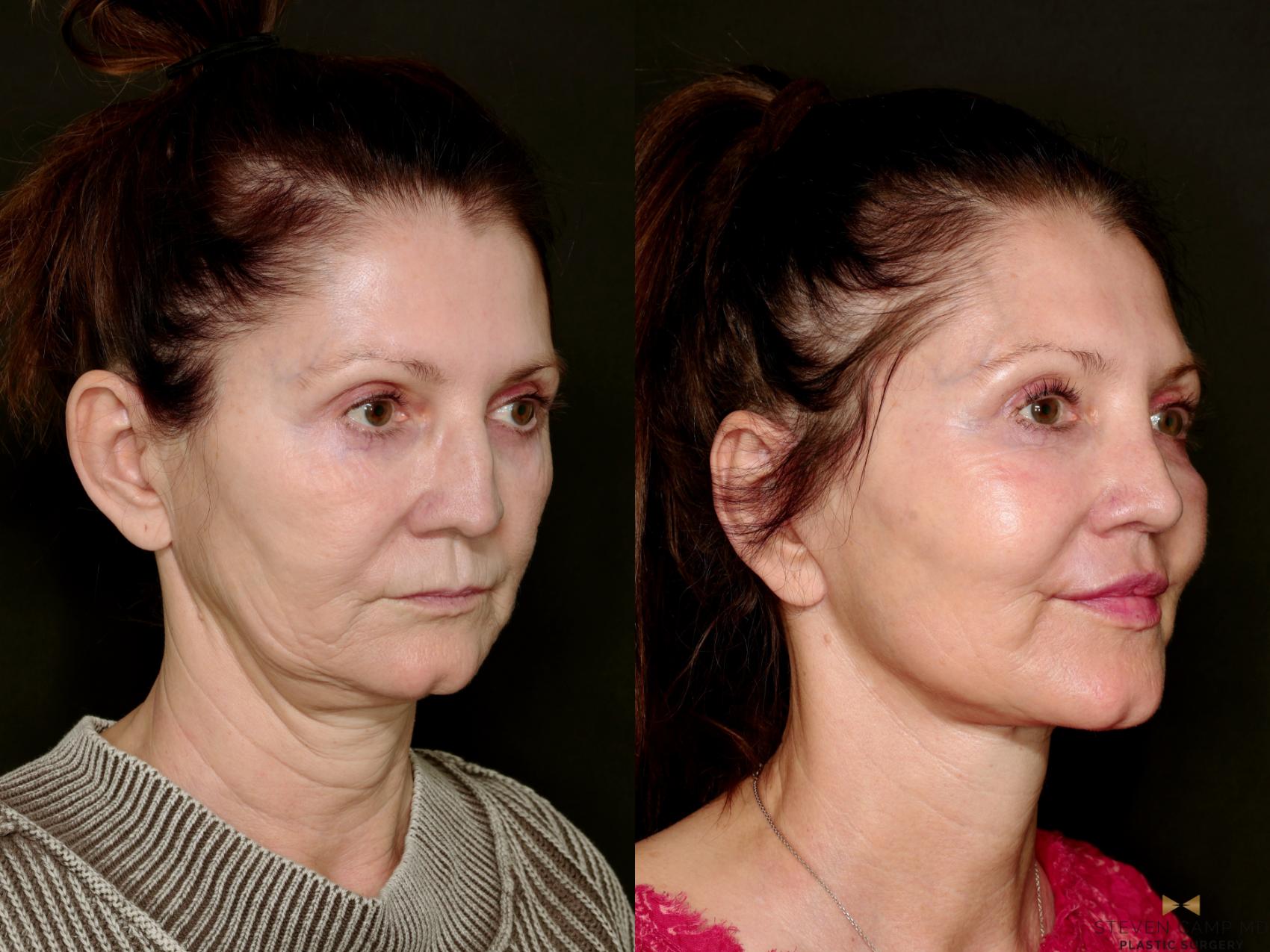 Before & After Deep Plane Facelift Case 745 Right Oblique View in Fort Worth & Arlington, Texas