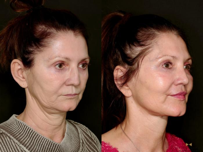 Before & After Deep Plane Facelift Case 745 Right Oblique View in Fort Worth & Arlington, Texas