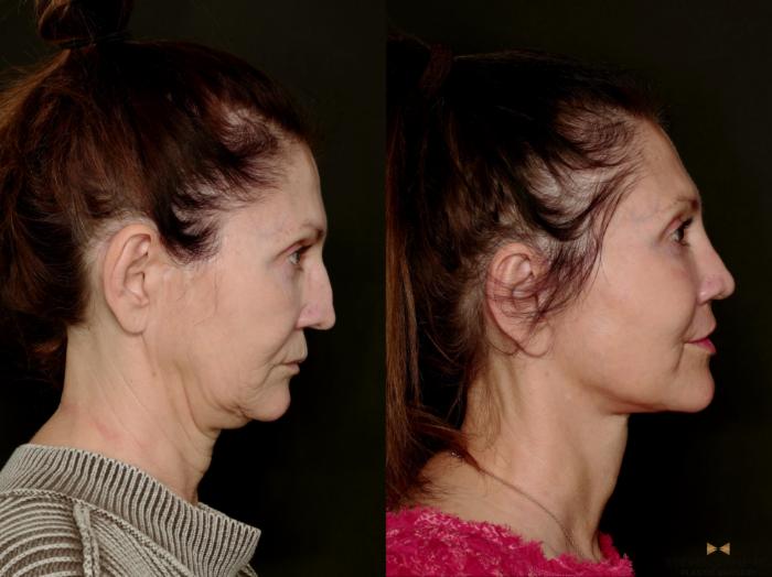 Before & After Deep Plane Facelift Case 745 Right Side View in Fort Worth & Arlington, Texas