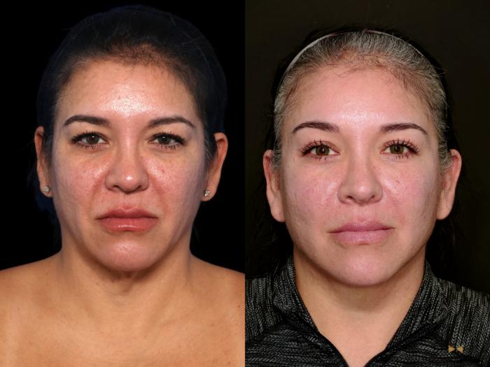 Before & After Deep Plane Facelift Case 748 Front View in Fort Worth & Arlington, Texas