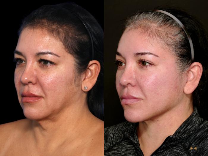 Before & After Deep Plane Facelift Case 748 Left Oblique View in Fort Worth & Arlington, Texas