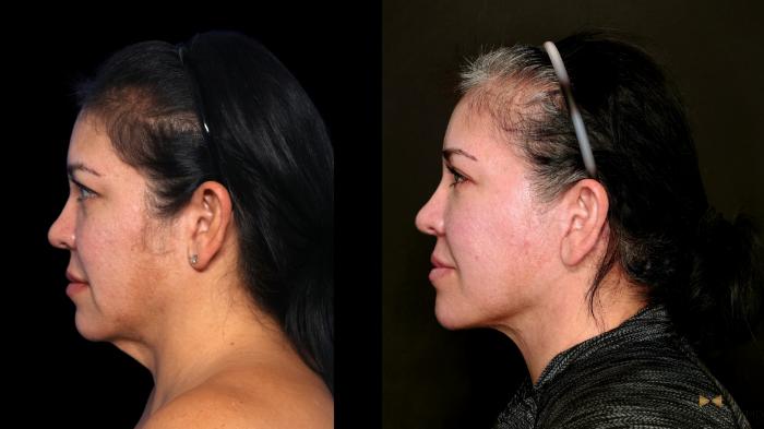 Before & After Deep Plane Facelift Case 748 Left Side View in Fort Worth & Arlington, Texas