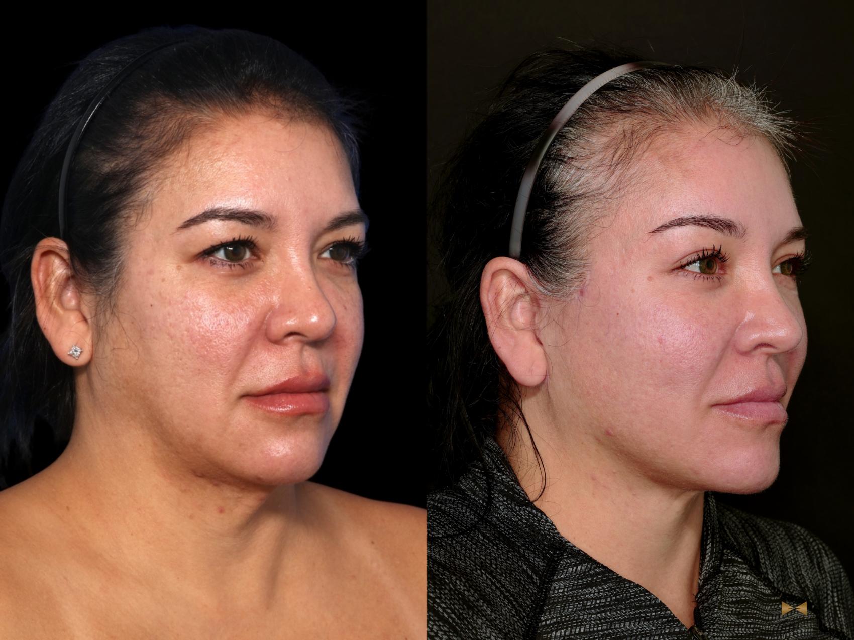 Before & After Deep Plane Facelift Case 748 Right Oblique View in Fort Worth & Arlington, Texas