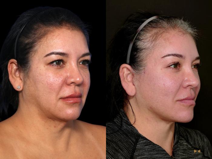 Before & After Deep Plane Facelift Case 748 Right Oblique View in Fort Worth & Arlington, Texas