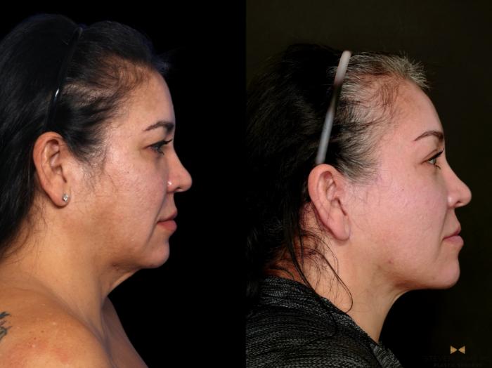 Before & After Deep Plane Facelift Case 748 Right Side View in Fort Worth & Arlington, Texas