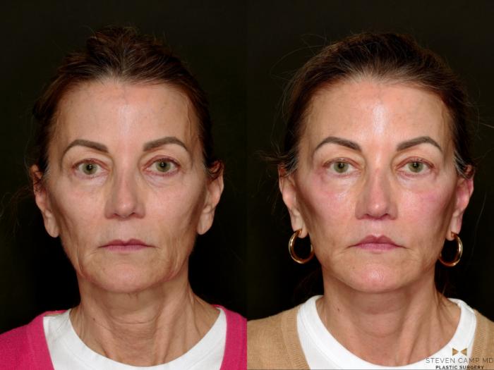 Before & After Deep Plane Facelift Case 750 Front View in Fort Worth & Arlington, Texas