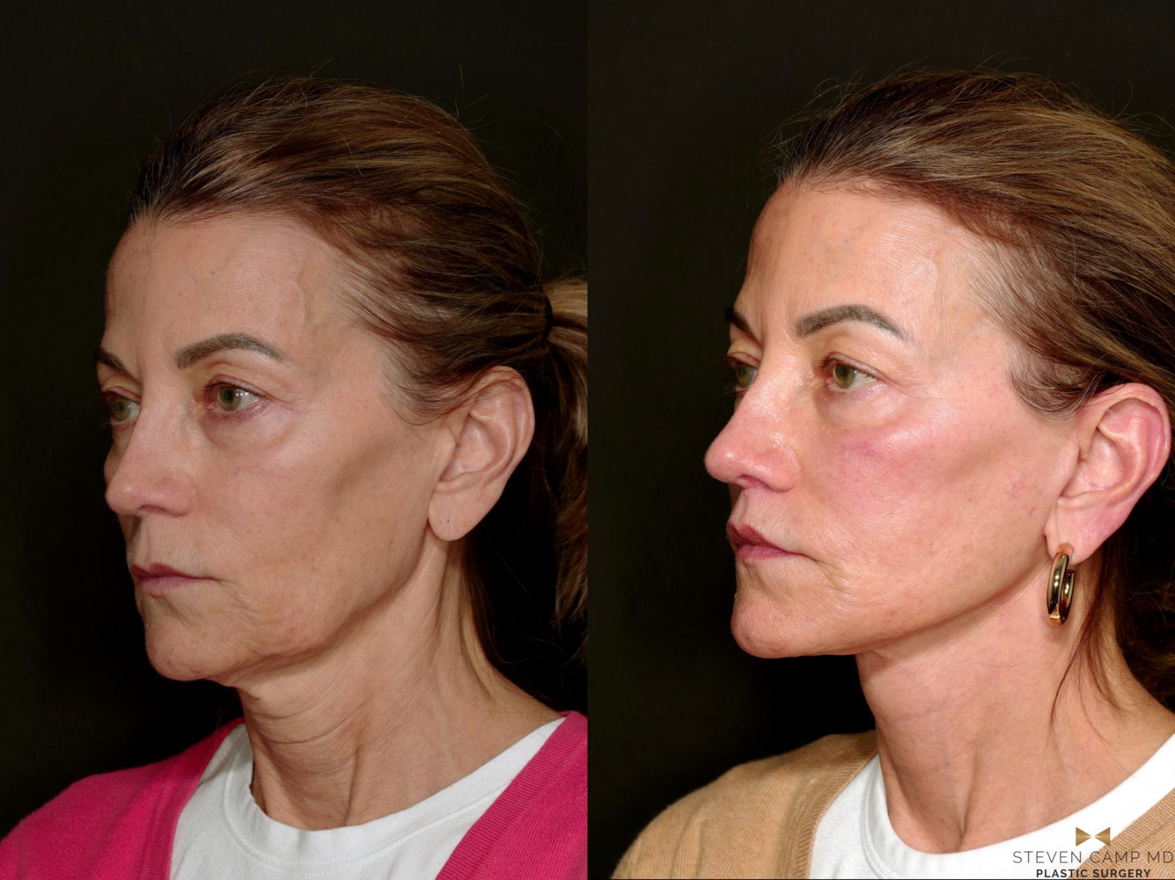 Before & After Deep Plane Facelift Case 750 Left Oblique View in Fort Worth & Arlington, Texas