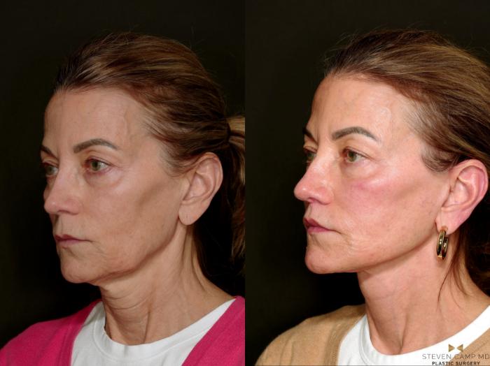 Before & After Deep Plane Facelift Case 750 Left Oblique View in Fort Worth & Arlington, Texas