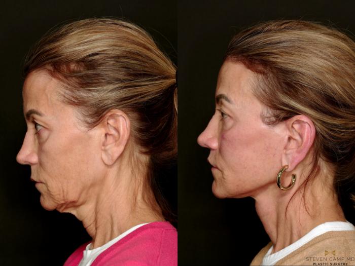Before & After Deep Plane Facelift Case 750 Left Side View in Fort Worth & Arlington, Texas