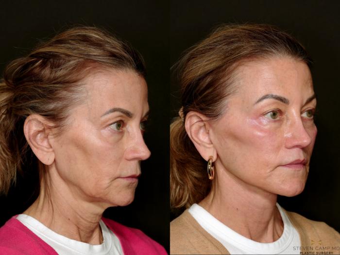 Before & After Deep Plane Facelift Case 750 Right Oblique View in Fort Worth & Arlington, Texas