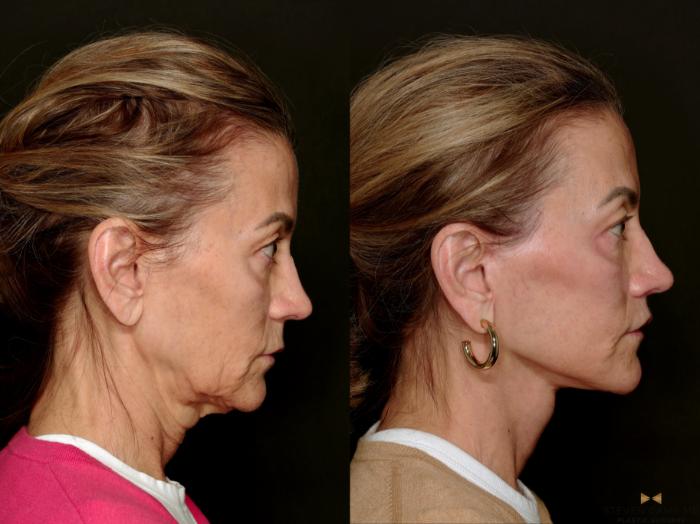 Before & After Deep Plane Facelift Case 750 Right Side View in Fort Worth & Arlington, Texas