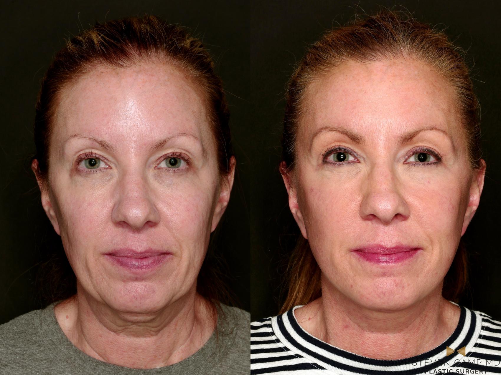 Before & After Deep Plane Facelift Case 753 Front View in Fort Worth & Arlington, Texas