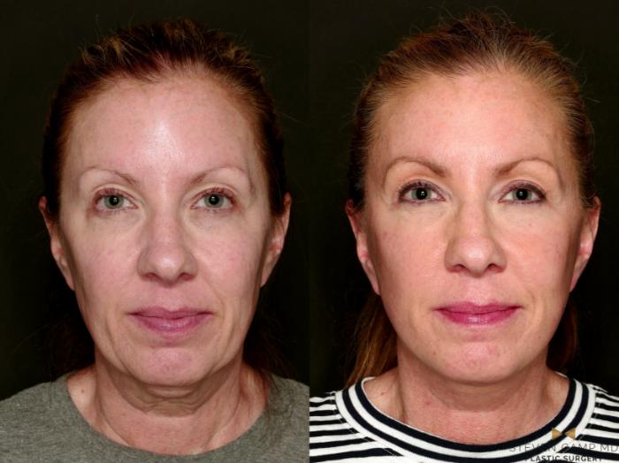 Before & After Deep Plane Facelift Case 753 Front View in Fort Worth & Arlington, Texas