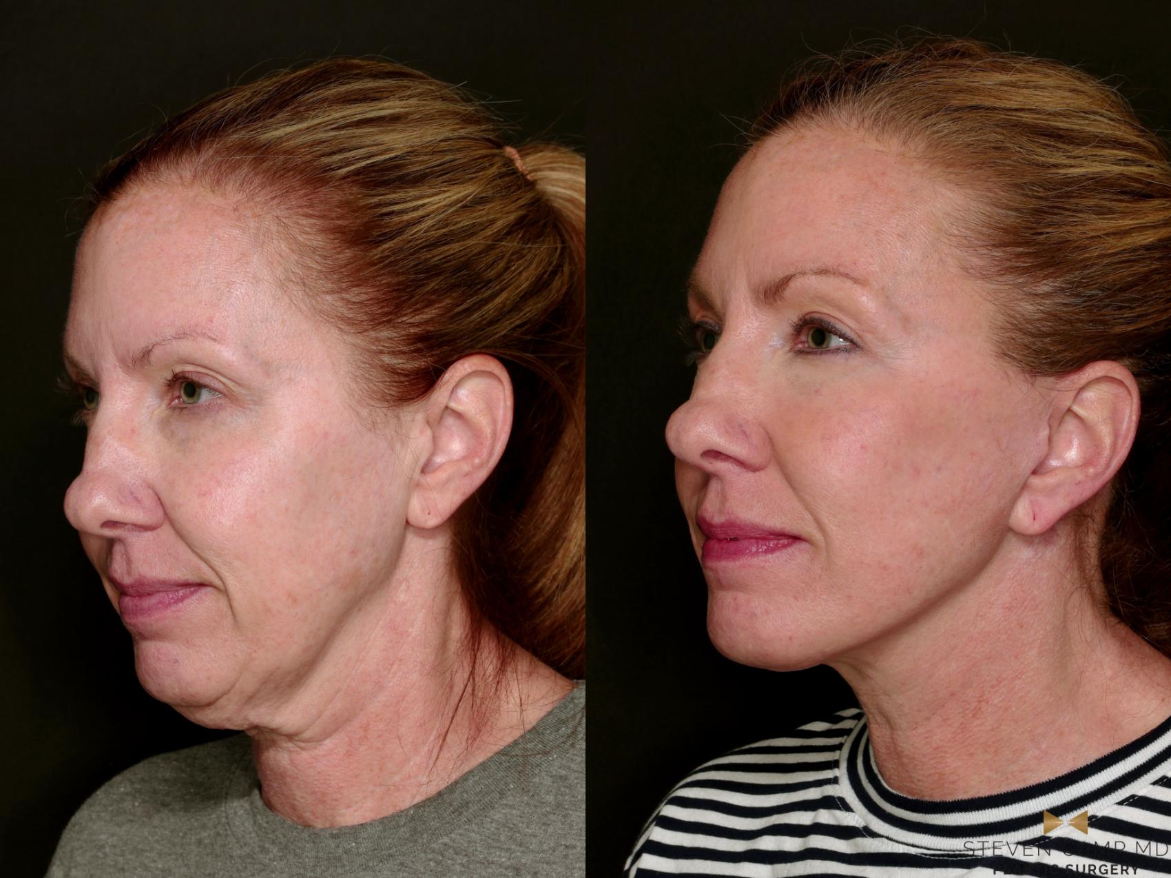 Before & After Deep Plane Facelift Case 753 Left Oblique View in Fort Worth & Arlington, Texas