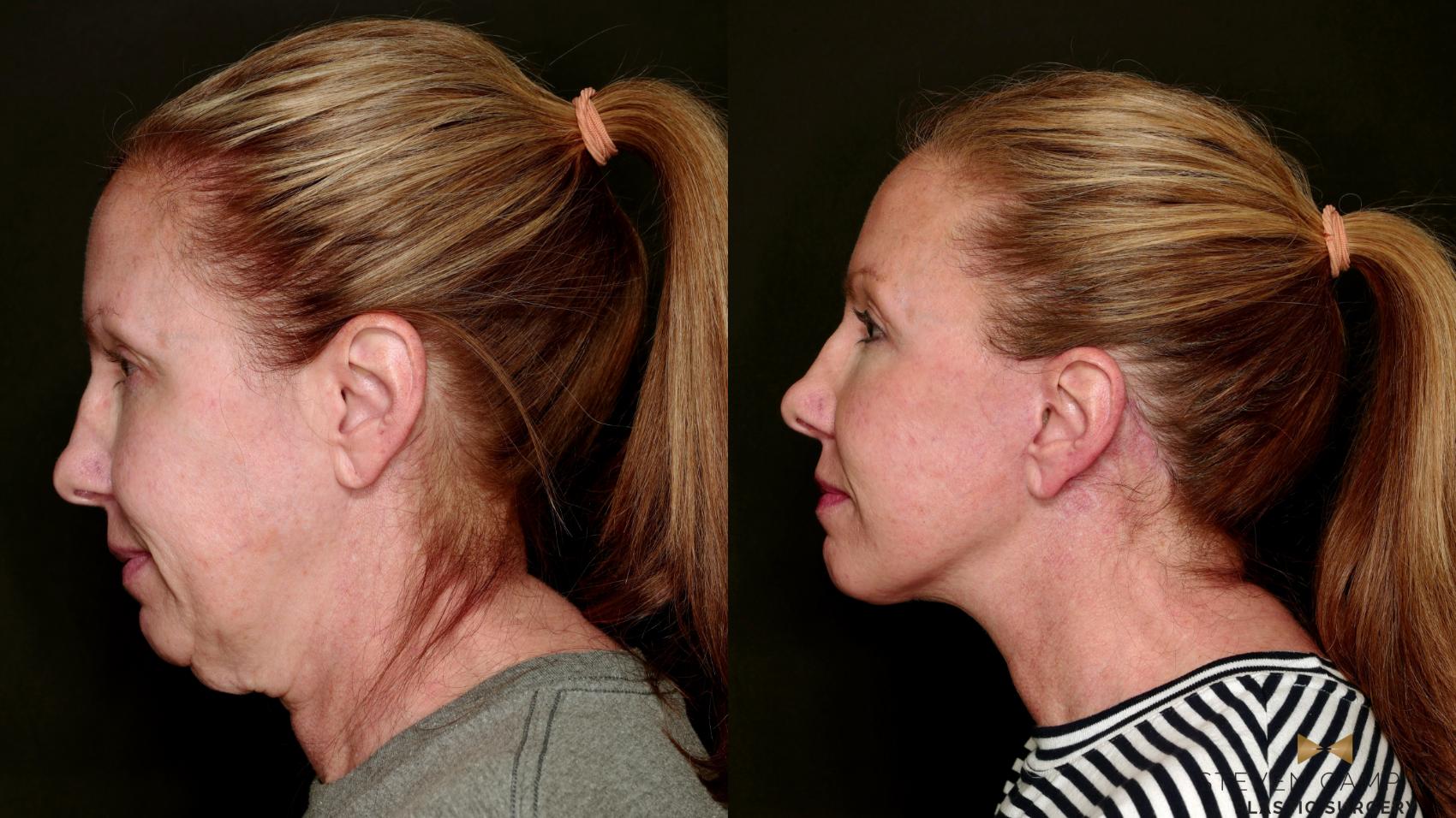 Before & After Deep Plane Facelift Case 753 Left Side View in Fort Worth & Arlington, Texas