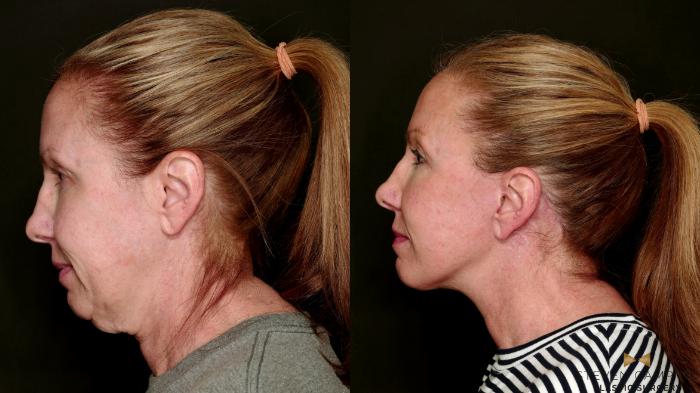 Before & After Deep Plane Facelift Case 753 Left Side View in Fort Worth & Arlington, Texas