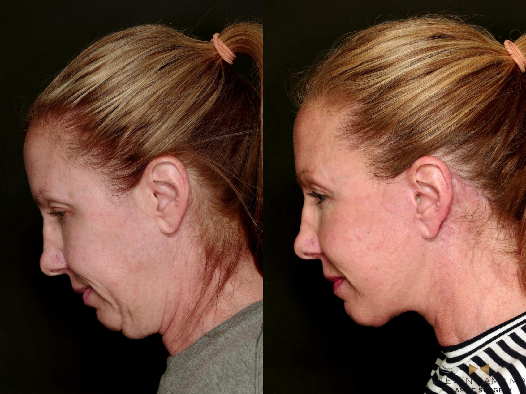 Before & After Deep Plane Facelift Case 753 Looking Down Side Left  View in Fort Worth & Arlington, Texas