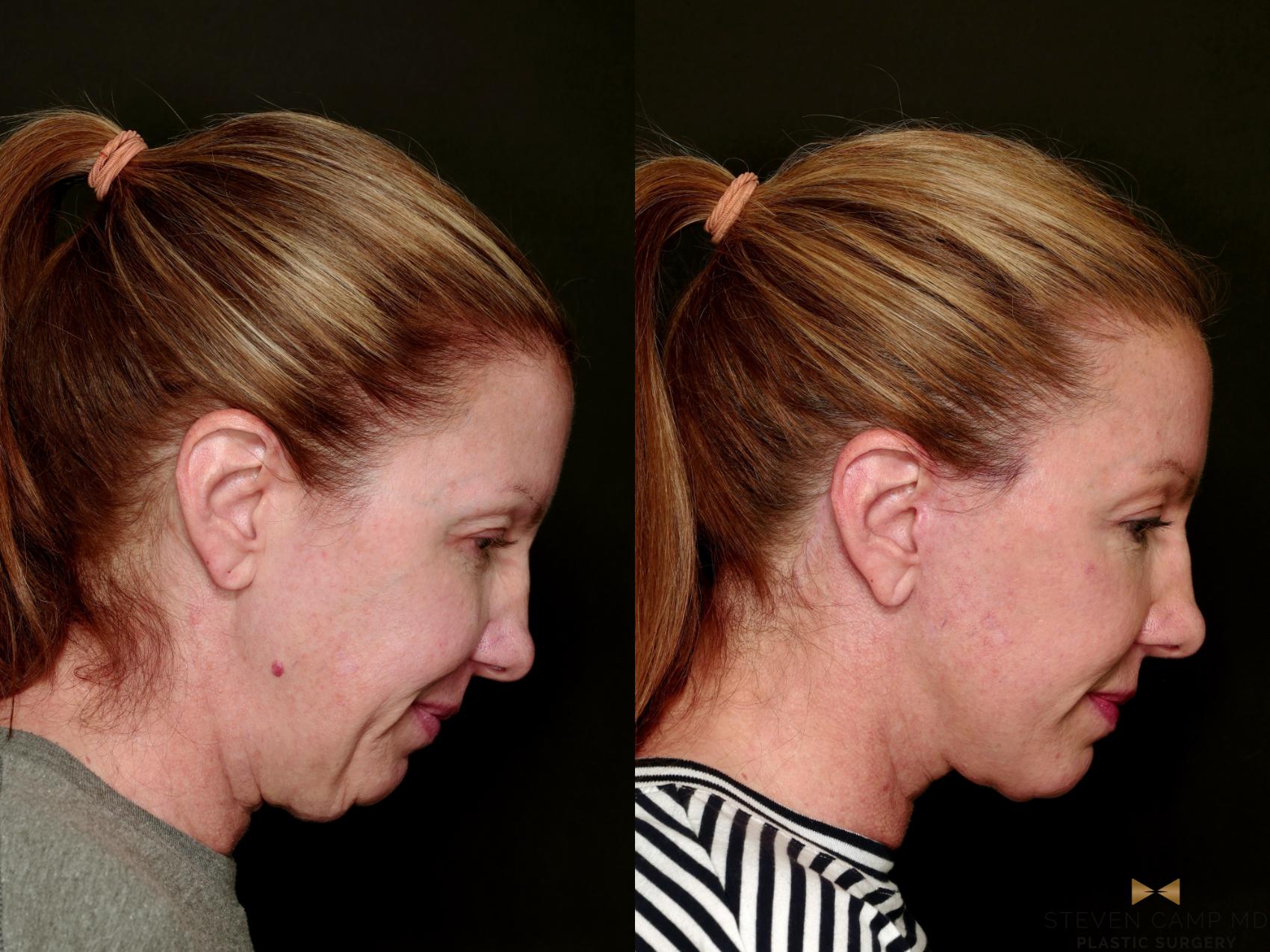 Before & After Deep Plane Facelift Case 753 Looking Down Side Right View in Fort Worth & Arlington, Texas