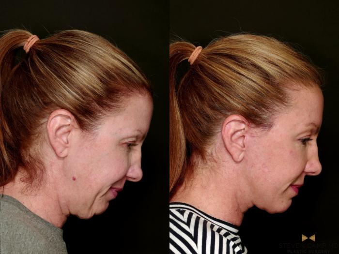 Before & After Deep Plane Facelift Case 753 Looking Down Side Right View in Fort Worth & Arlington, Texas