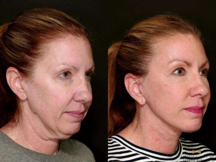 Before & After Deep Plane Facelift Case 753 Right Oblique View in Fort Worth & Arlington, Texas