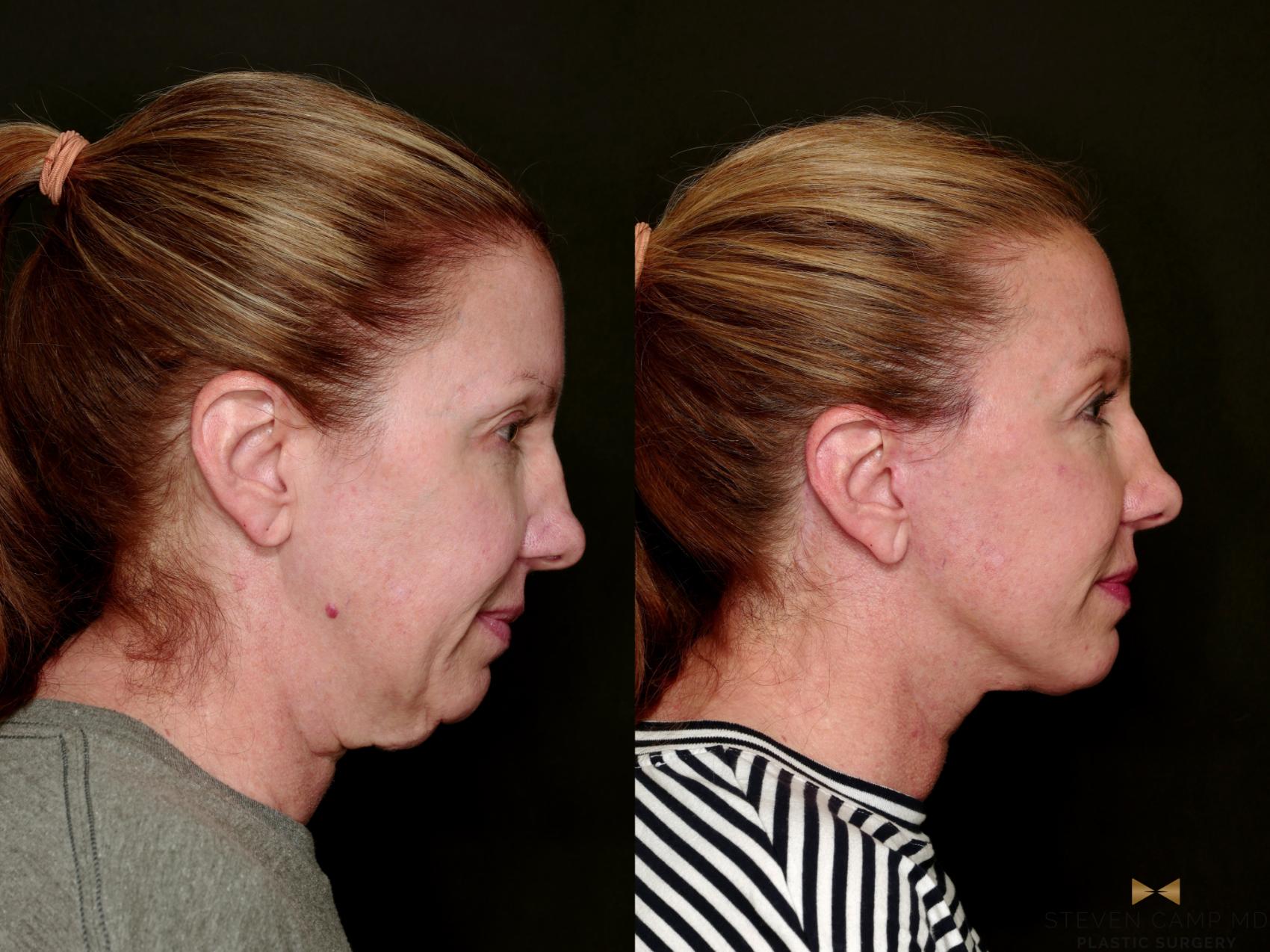 Before & After Deep Plane Facelift Case 753 Right Side View in Fort Worth & Arlington, Texas