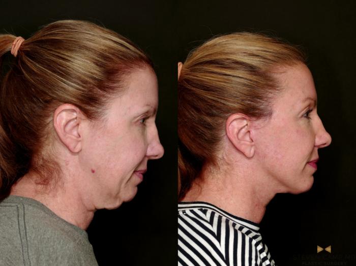 Before & After Deep Plane Facelift Case 753 Right Side View in Fort Worth & Arlington, Texas