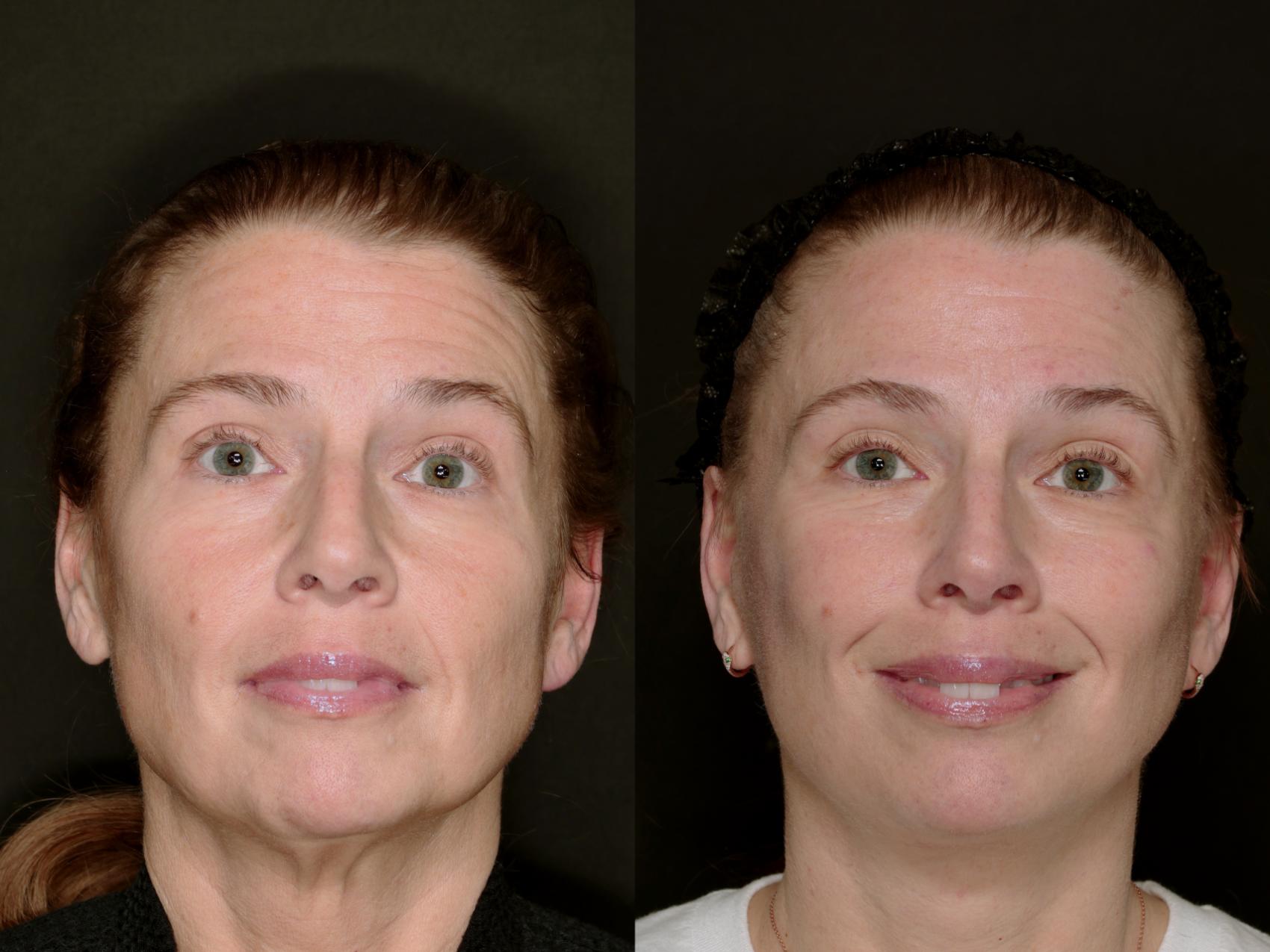 Before & After Deep Plane Facelift Case 783  View in Fort Worth & Arlington, Texas