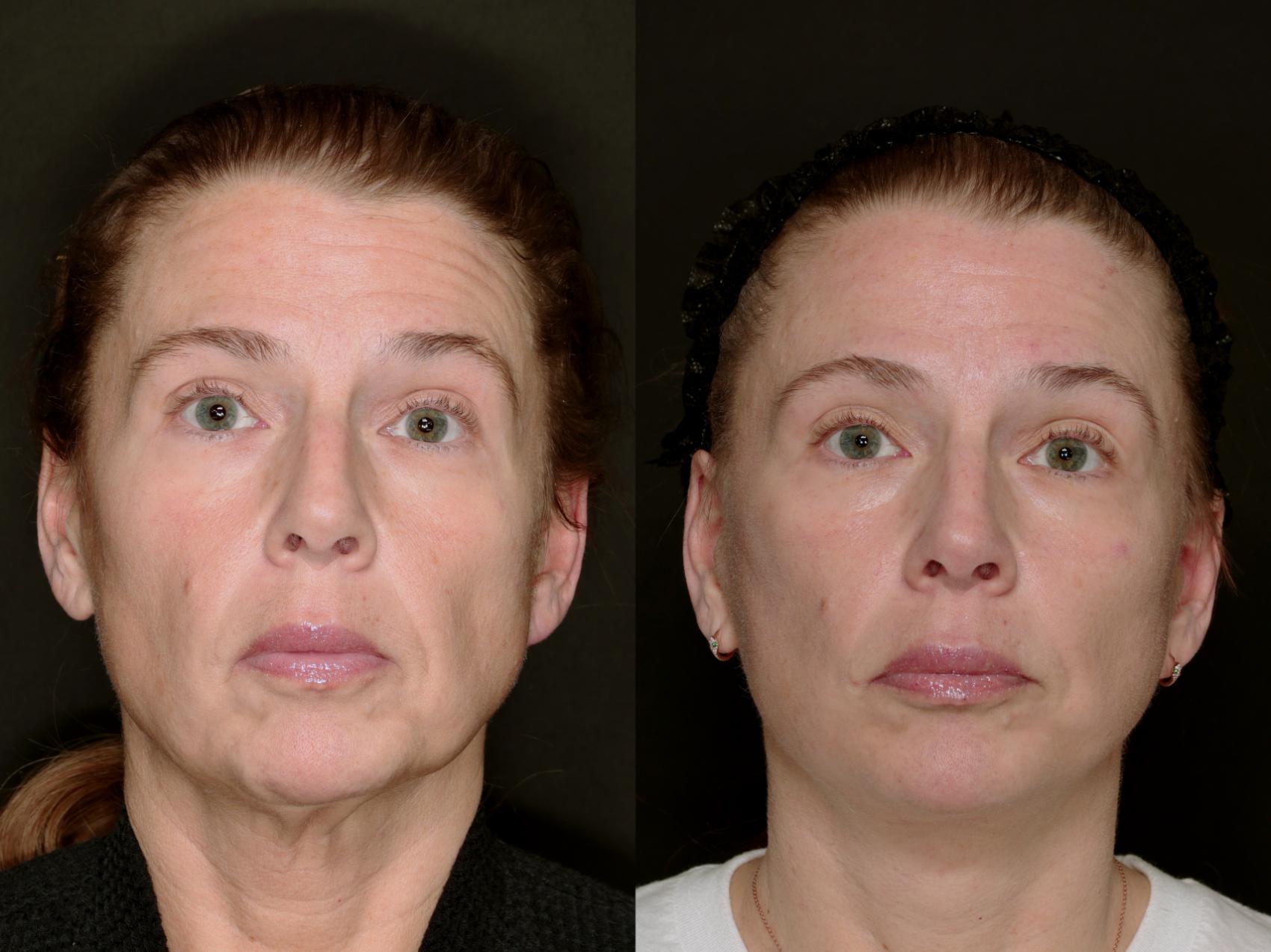 Before & After Deep Plane Facelift Case 783 Front View in Fort Worth & Arlington, Texas