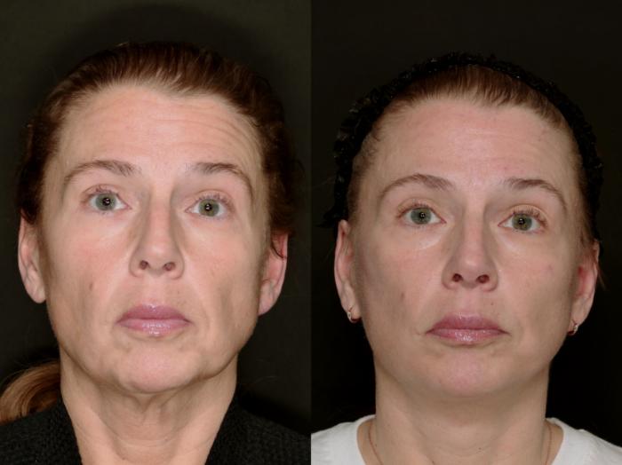 Before & After Deep Plane Facelift Case 783 Front View in Fort Worth & Arlington, Texas