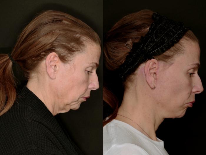 Before & After Deep Plane Facelift Case 783 Lateral Looking Down  View in Fort Worth & Arlington, Texas