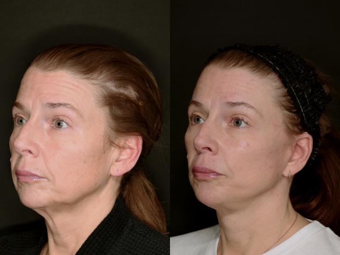 Before & After Deep Plane Facelift Case 783 Left Oblique View in Fort Worth & Arlington, Texas