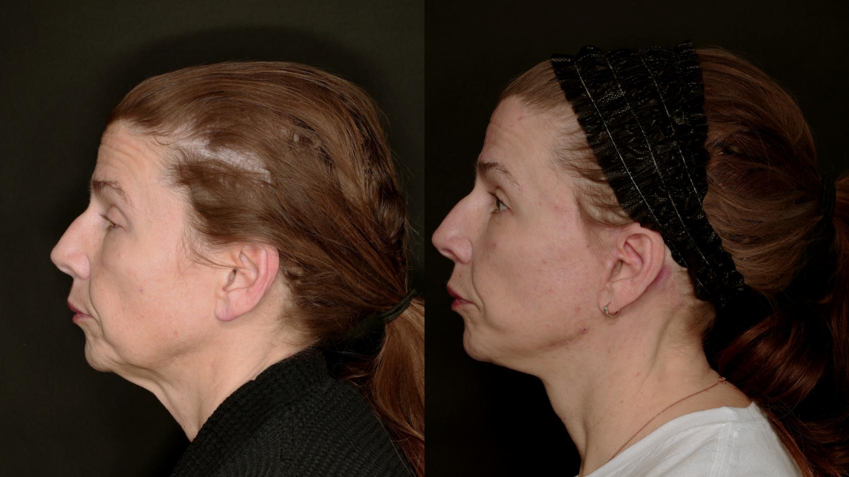 Before & After Deep Plane Facelift Case 783 Left Side View in Fort Worth & Arlington, Texas
