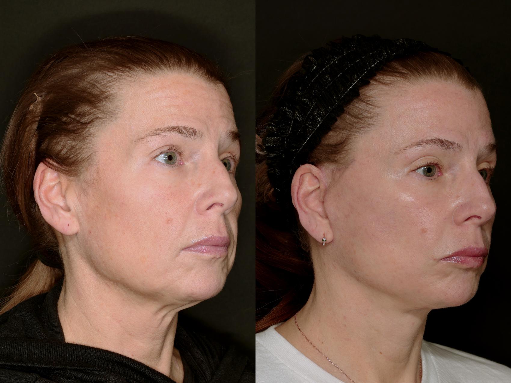 Before & After Deep Plane Facelift Case 783 Right Oblique View in Fort Worth & Arlington, Texas