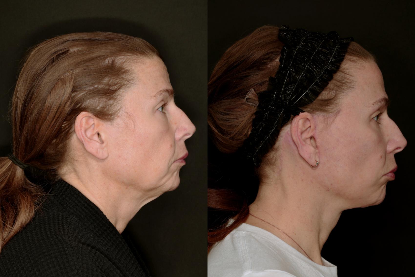 Before & After Deep Plane Facelift Case 783 Right Side View in Fort Worth & Arlington, Texas
